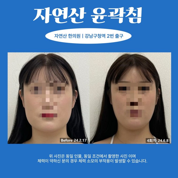 masseter-tension-relief 치료 사례 1 — 시술 전후 비교