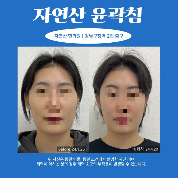 masseter-tension-relief 치료 사례 2 — 시술 전후 비교