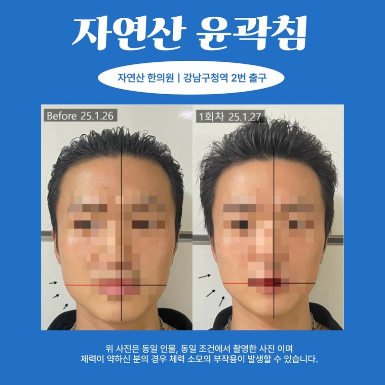 masseter-tension-relief 치료 사례 3 — 시술 전후 비교