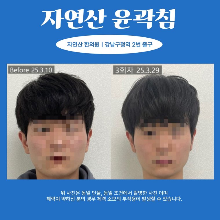 masseter-tension-relief 치료 사례 4 — 시술 전후 비교