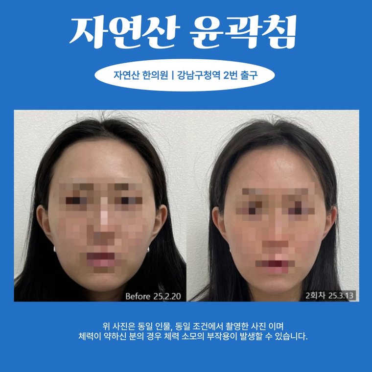 masseter-tension-relief 치료 사례 5 — 시술 전후 비교