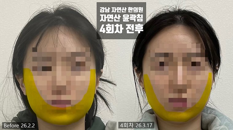 masseter-tension-shrink 치료 사례 1 — 시술 전후 비교