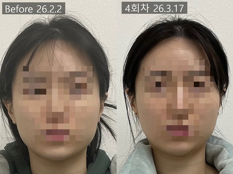 masseter-tension-shrink 치료 사례 2 — 시술 전후 비교