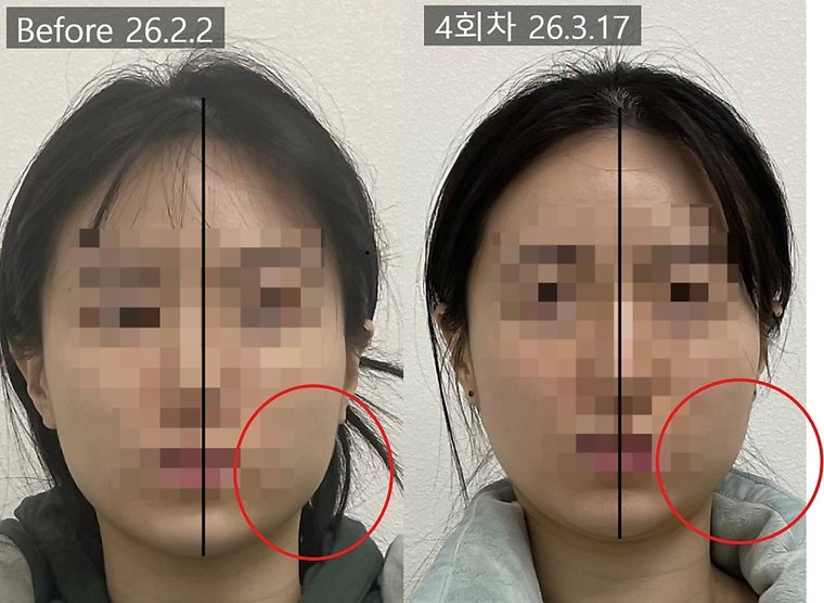 masseter-tension-shrink 치료 사례 3 — 시술 전후 비교