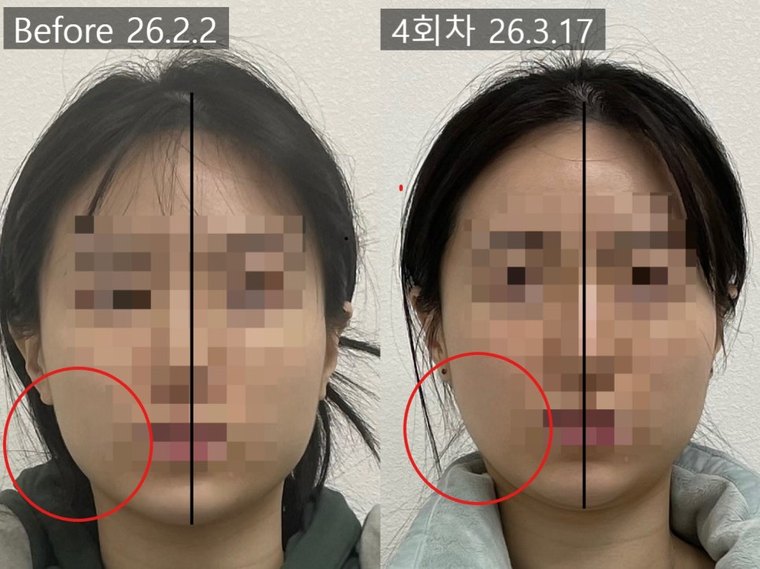 masseter-tension-shrink 치료 사례 4 — 시술 전후 비교