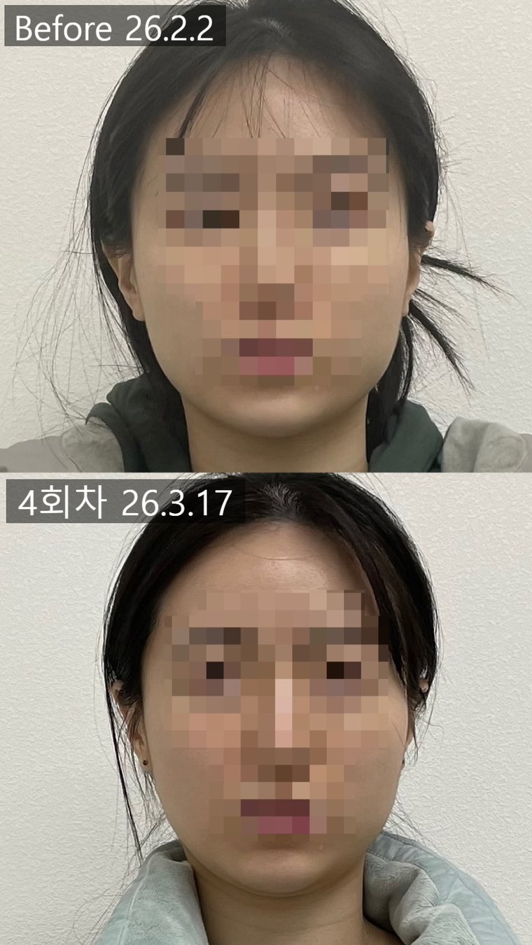 masseter-tension-shrink 치료 사례 5 — 시술 전후 비교