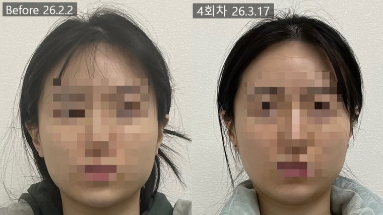 masseter-tension-shrink 치료 사례 6 — 시술 전후 비교