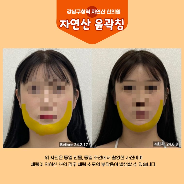 masticatory-muscles 치료 사례 1 — 시술 전후 비교