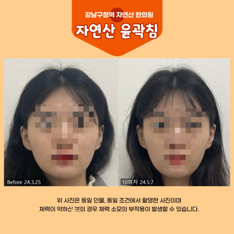 masticatory-muscles 치료 사례 2 — 시술 전후 비교