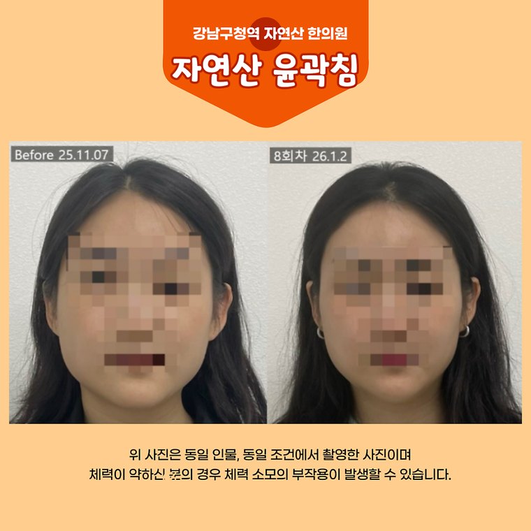 masticatory-muscles 치료 사례 3 — 시술 전후 비교