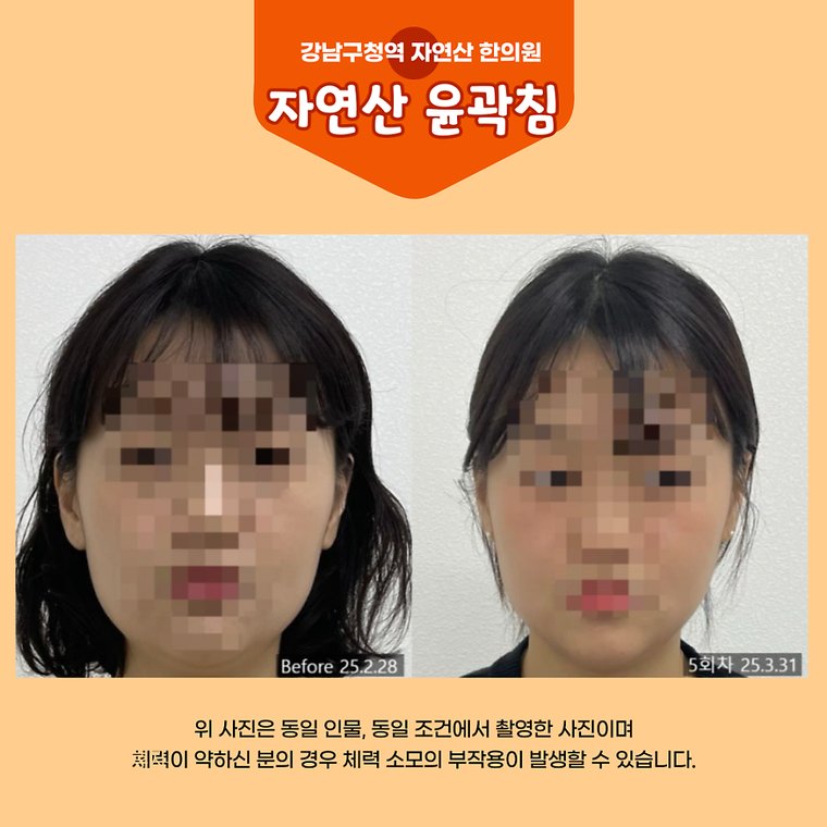 masticatory-muscles 치료 사례 4 — 시술 전후 비교