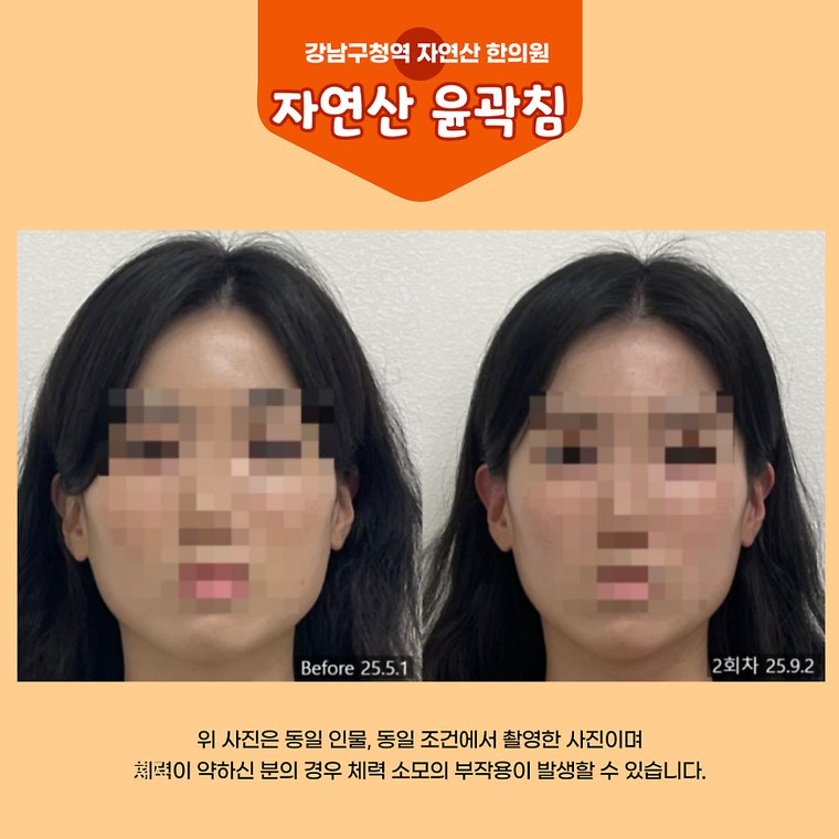 masticatory-muscles 치료 사례 5 — 시술 전후 비교