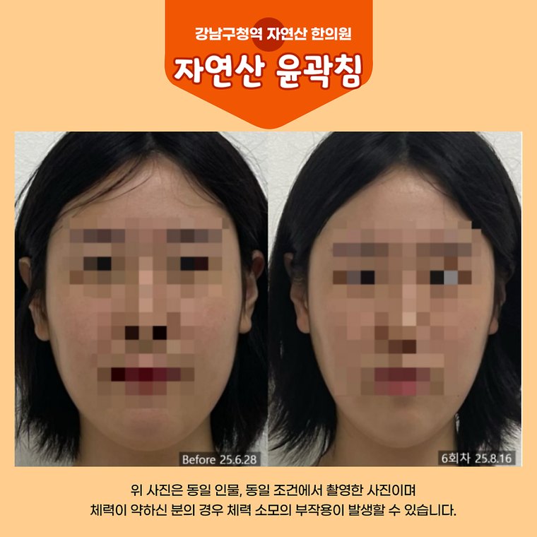 masticatory-muscles 치료 사례 6 — 시술 전후 비교