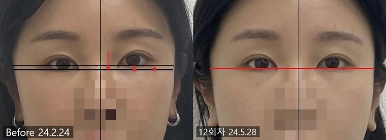 midface-length-check 치료 사례 1 — 시술 전후 비교