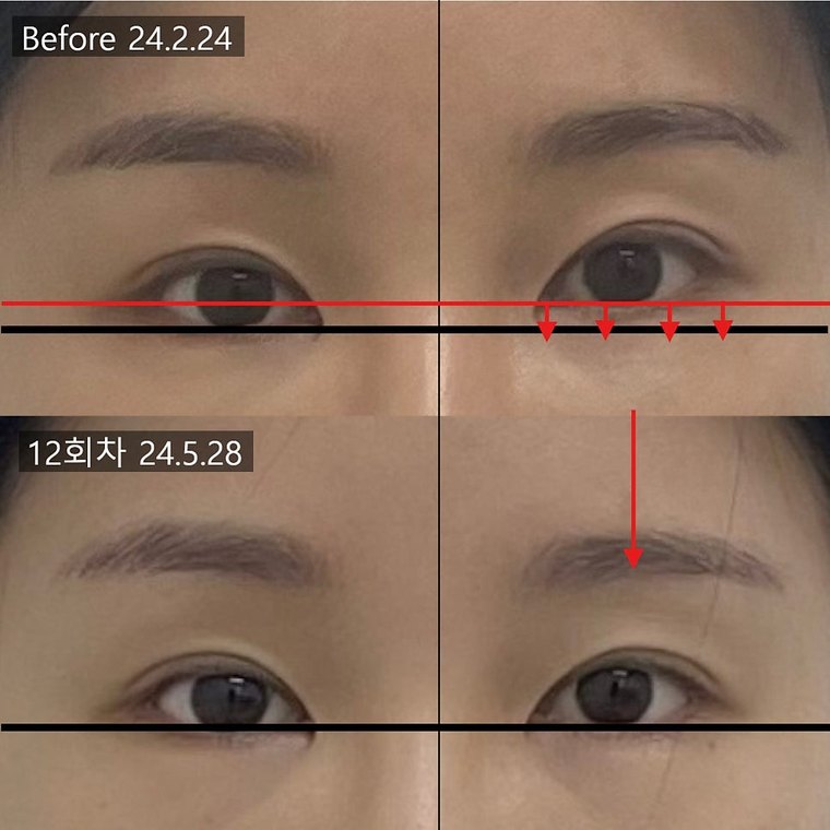 midface-length-check 치료 사례 2 — 시술 전후 비교