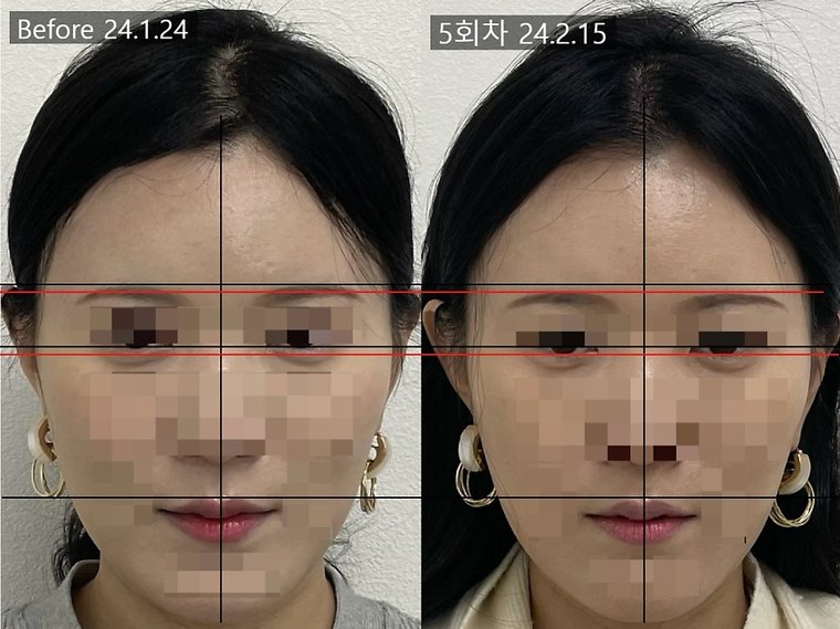 midface-length-check 치료 사례 4 — 시술 전후 비교
