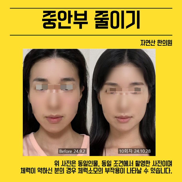 midface-reduction 치료 사례 1 — 시술 전후 비교