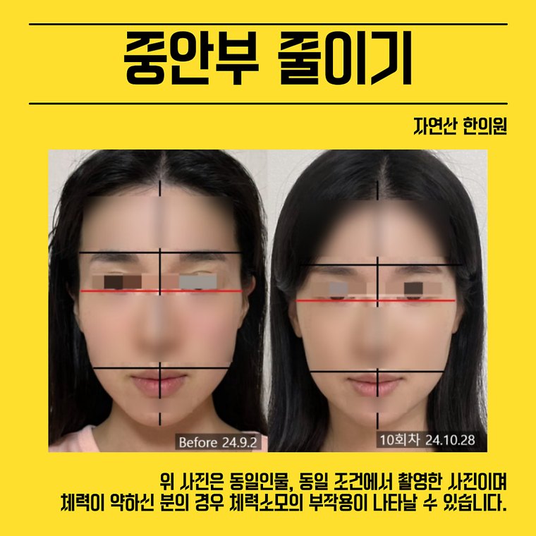 midface-reduction 치료 사례 2 — 시술 전후 비교