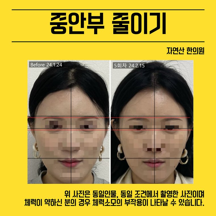 midface-reduction 치료 사례 4 — 시술 전후 비교