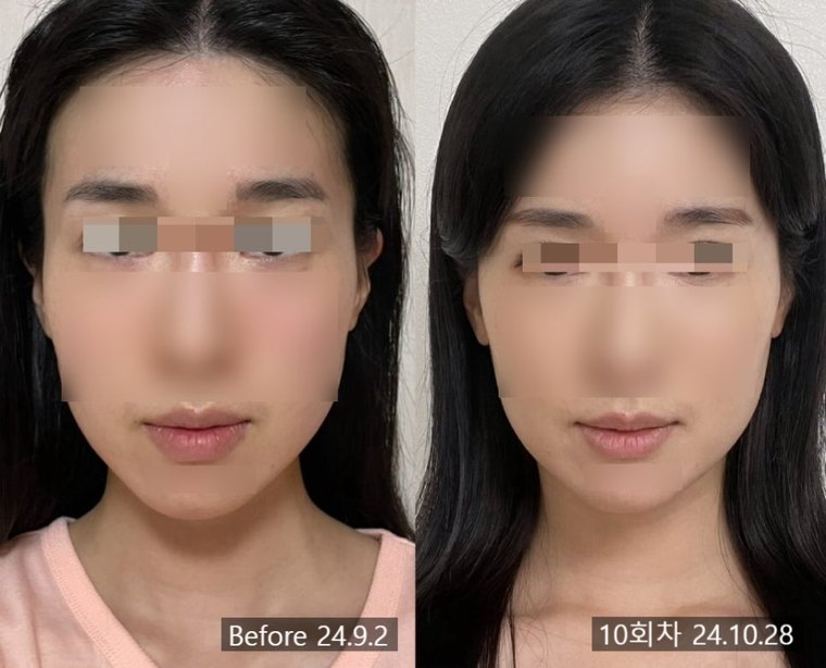 midface-reduction-acupuncture 치료 사례 2 — 시술 전후 비교