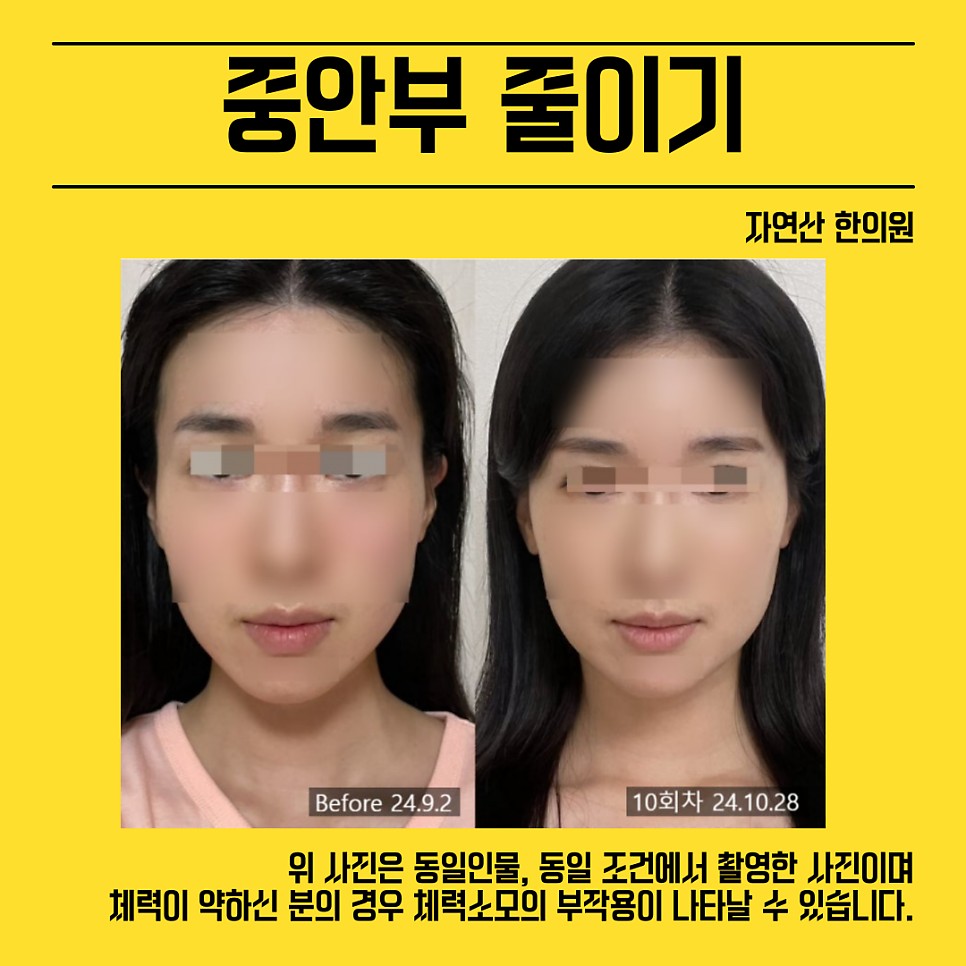 중안부 시술 기록 5 — 동일 인물·동일 조건에서 촬영한 보정 없는 원본 사진