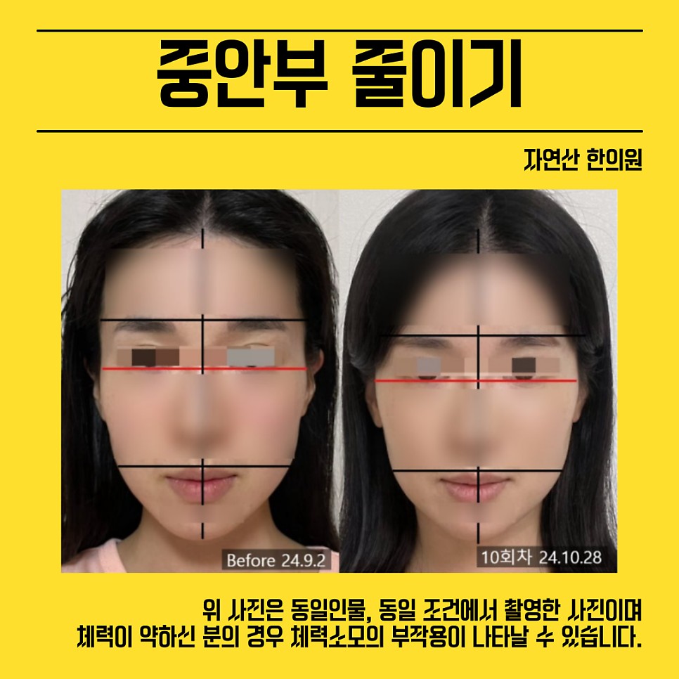 중안부 시술 기록 6 — 동일 인물·동일 조건에서 촬영한 보정 없는 원본 사진