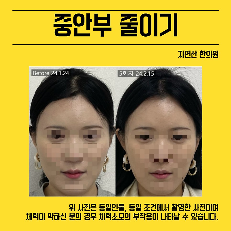 중안부 시술 기록 7 — 동일 인물·동일 조건에서 촬영한 보정 없는 원본 사진