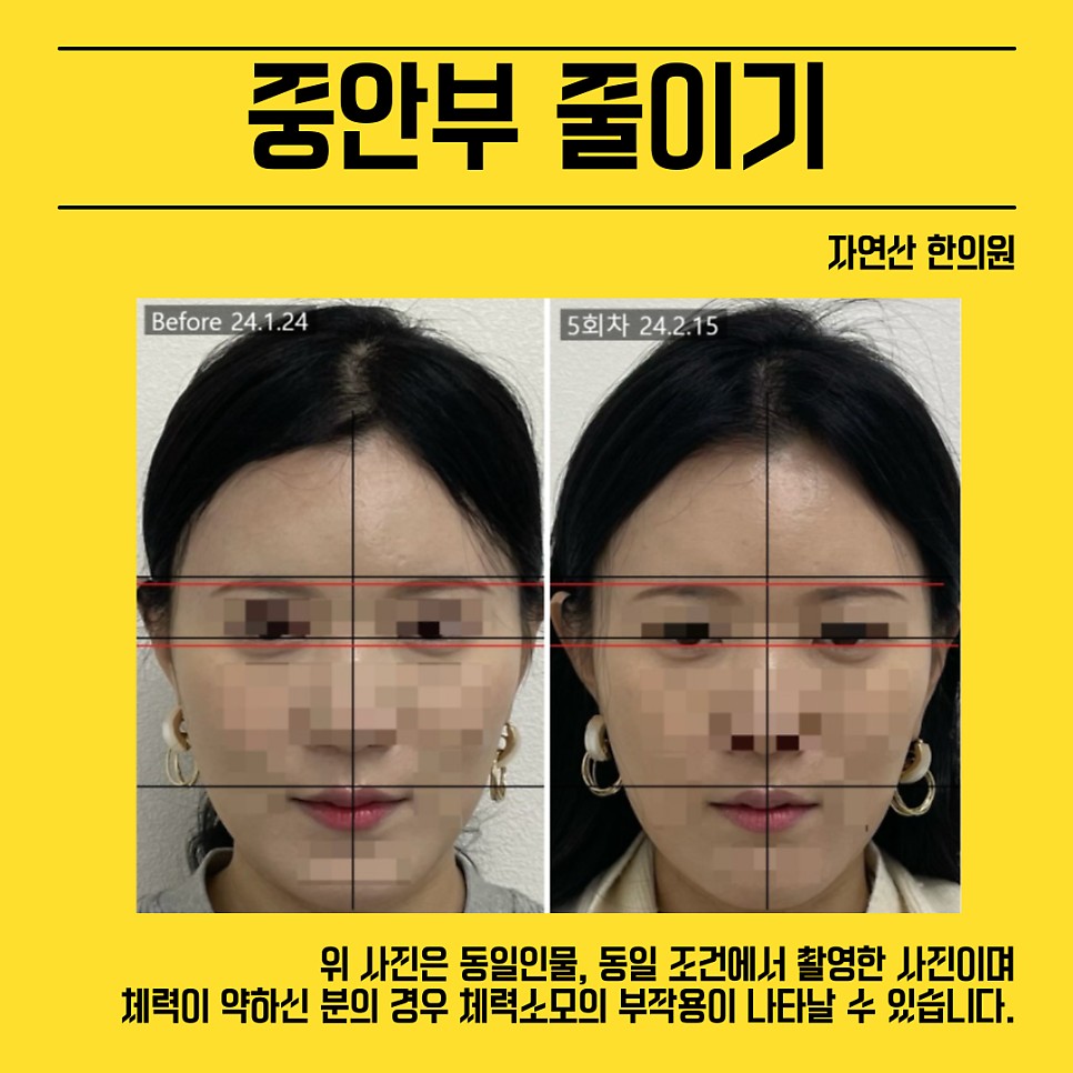 중안부 시술 기록 8 — 동일 인물·동일 조건에서 촬영한 보정 없는 원본 사진