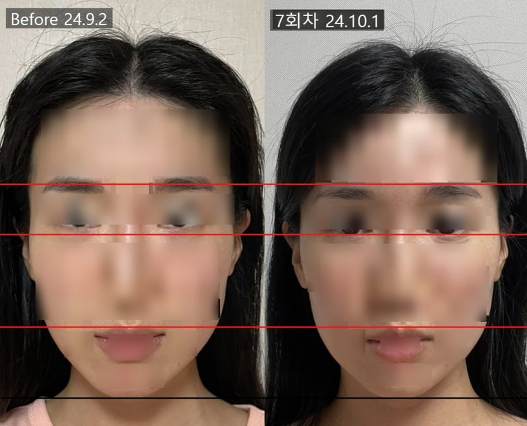 midface-reduction-procedure 치료 사례 3 — 시술 전후 비교