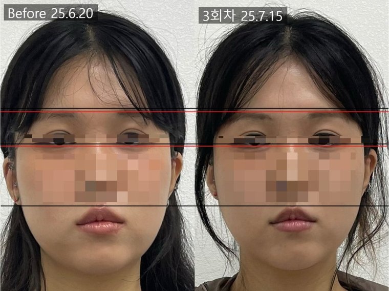 midface-reduction-result 치료 사례 2 — 시술 전후 비교