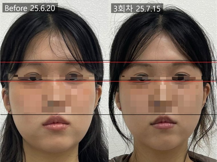 midface-reduction-result 치료 사례 3 — 시술 전후 비교