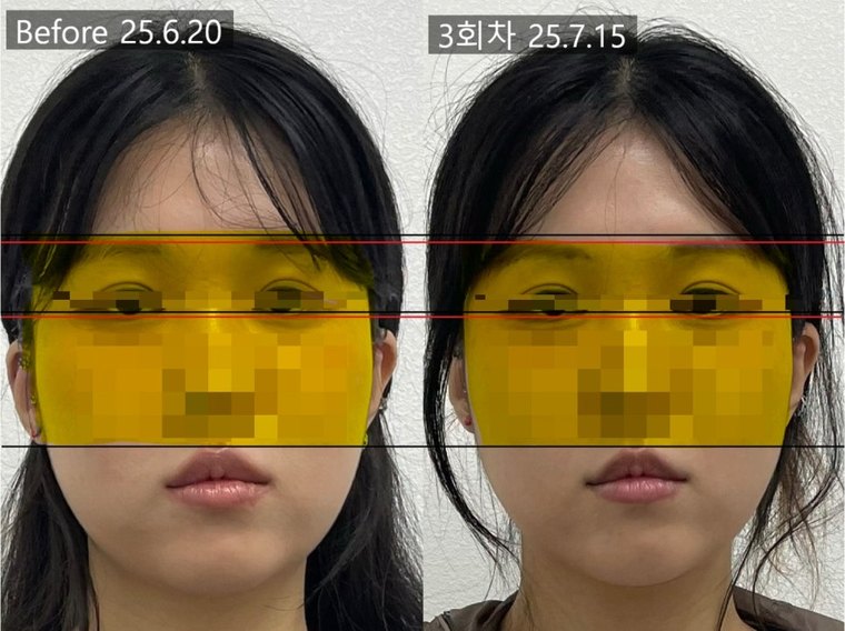 midface-reduction-result 치료 사례 4 — 시술 전후 비교