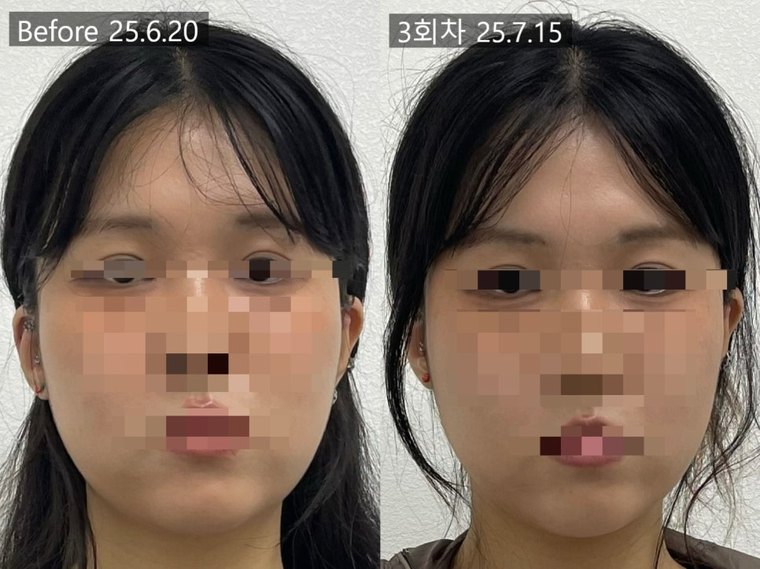 midface-reduction-result 치료 사례 5 — 시술 전후 비교