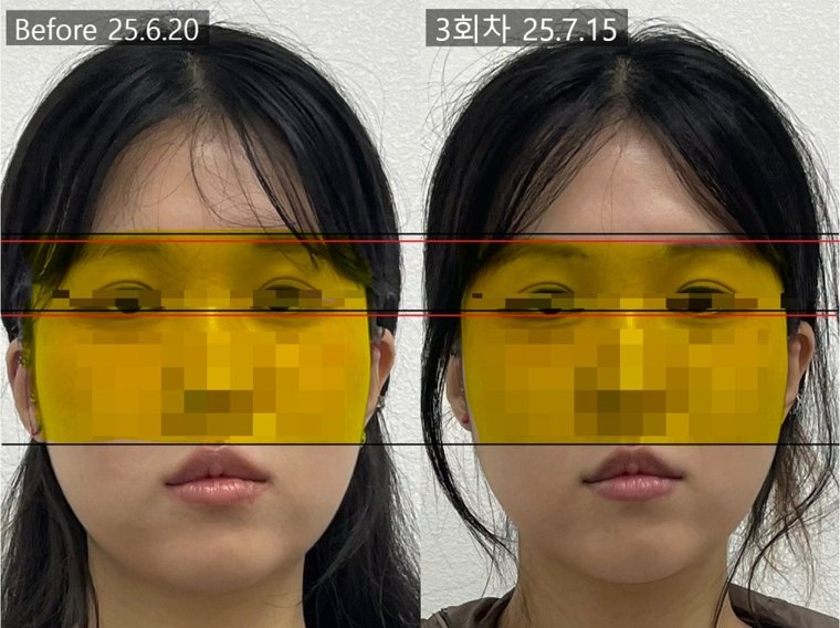 midface-reduction-result 치료 사례 6 — 시술 전후 비교