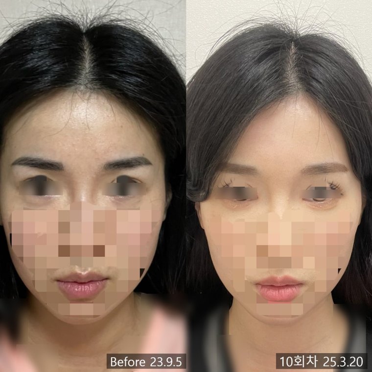 midface-reduction-surgery 치료 사례 1 — 시술 전후 비교