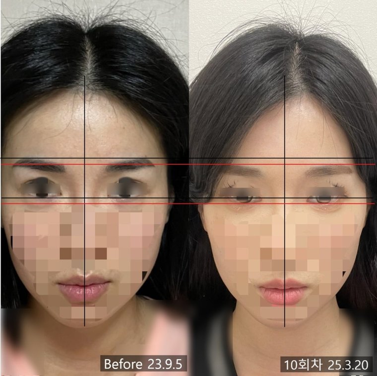midface-reduction-surgery 치료 사례 2 — 시술 전후 비교