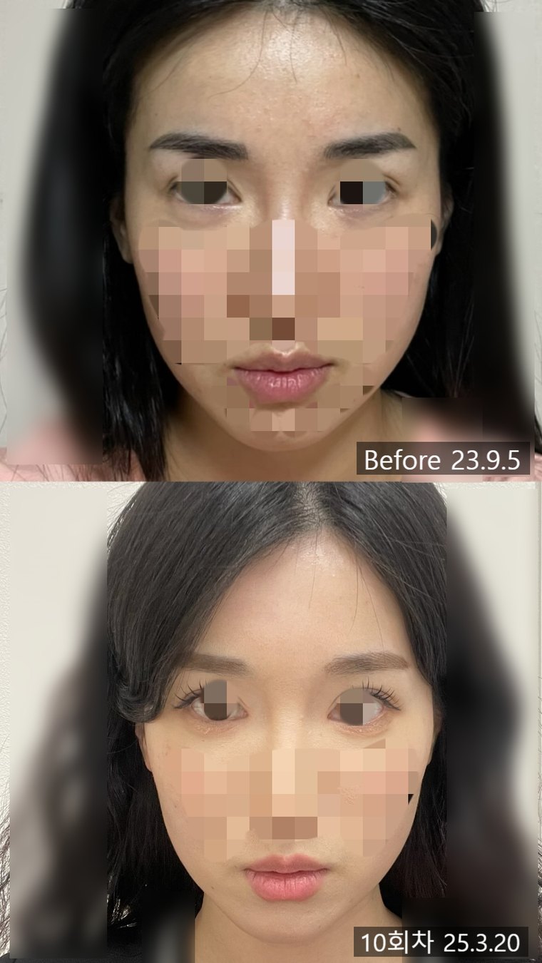 midface-reduction-surgery 치료 사례 3 — 시술 전후 비교