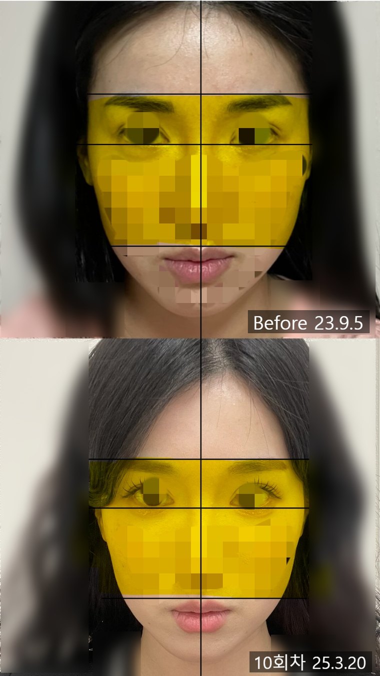 midface-reduction-surgery 치료 사례 4 — 시술 전후 비교