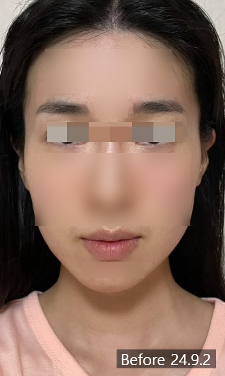 midface-shortening 치료 사례 1 — 시술 전후 비교