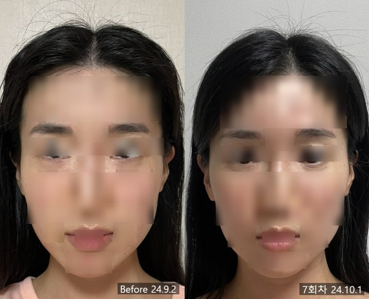 midface-shortening-method 치료 사례 1 — 시술 전후 비교