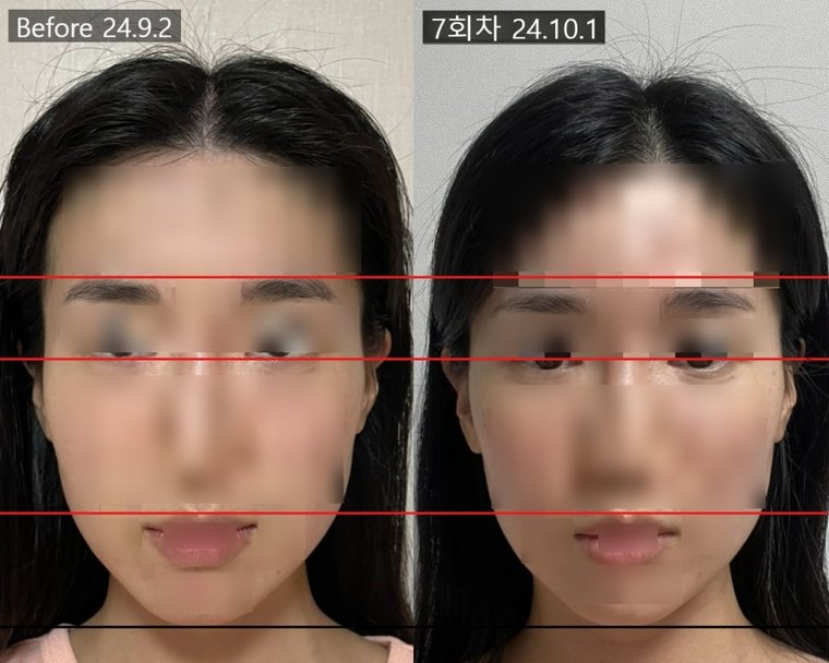 midface-shortening-method 치료 사례 2 — 시술 전후 비교