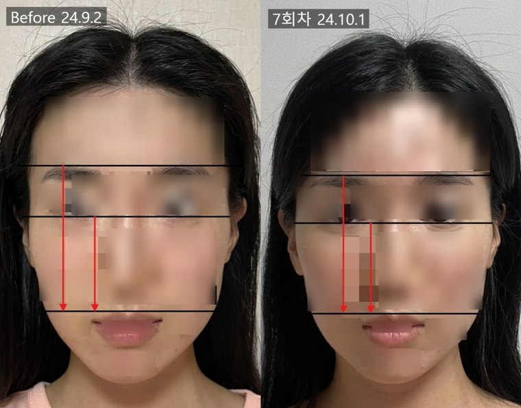 midface-shortening-method 치료 사례 4 — 시술 전후 비교