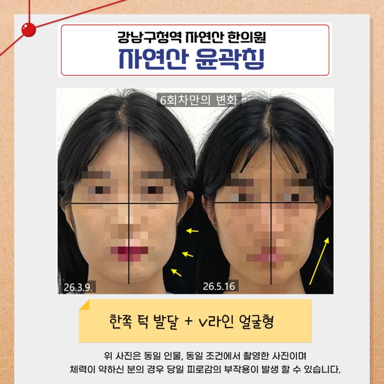one-sided-jaw-asymmetry 치료 사례 1 — 시술 전후 비교