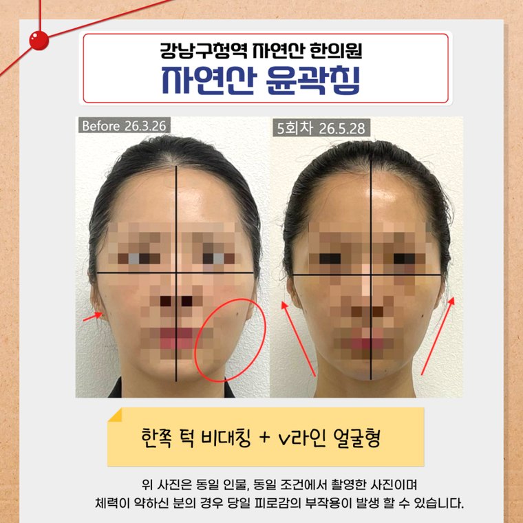 one-sided-jaw-asymmetry 치료 사례 2 — 시술 전후 비교