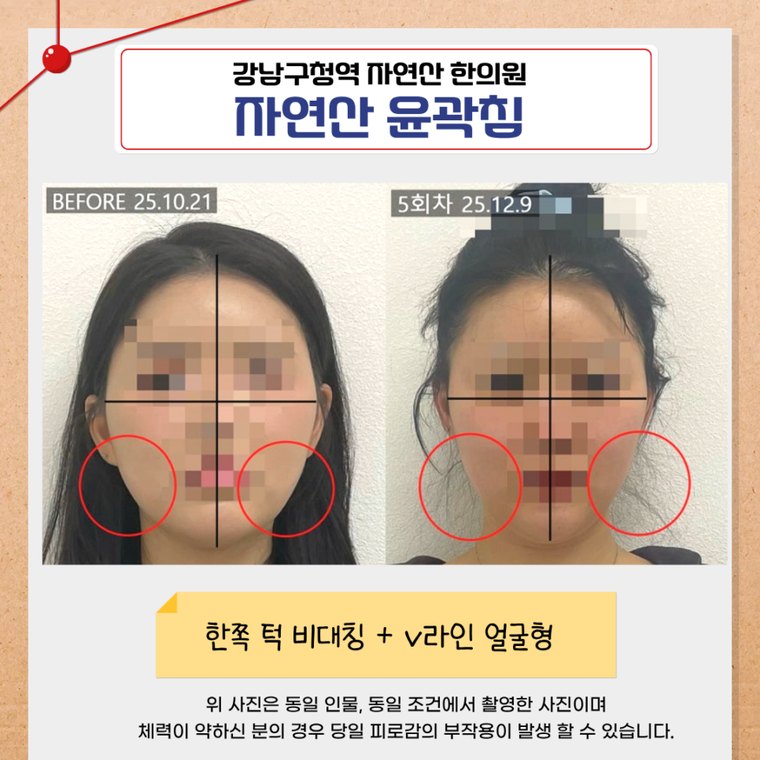 one-sided-jaw-asymmetry 치료 사례 3 — 시술 전후 비교