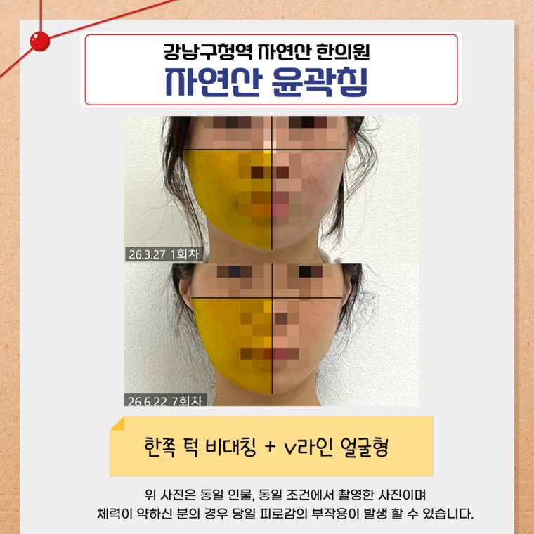 one-sided-jaw-asymmetry 치료 사례 4 — 시술 전후 비교