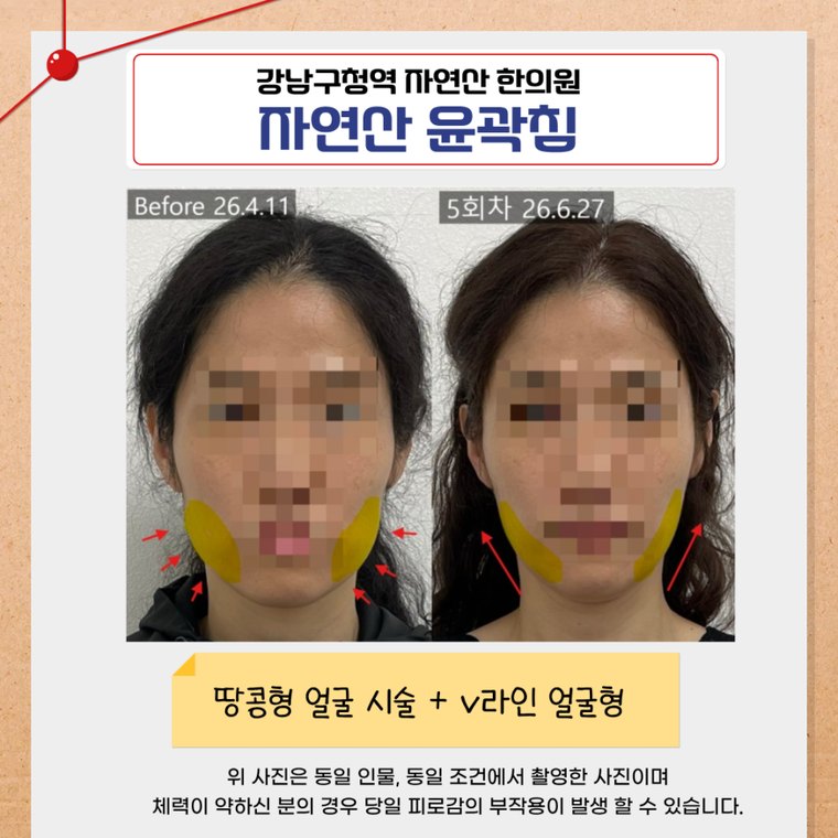 one-sided-jaw-asymmetry 치료 사례 5 — 시술 전후 비교