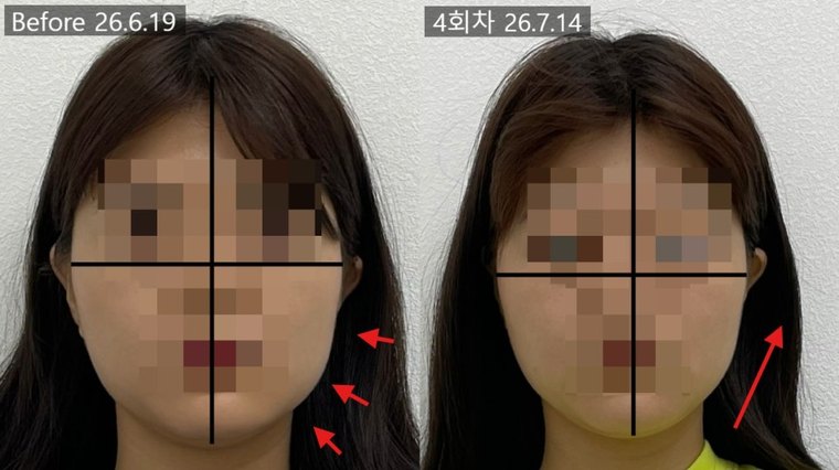 one-sided-jaw-asymmetry 치료 사례 6 — 시술 전후 비교