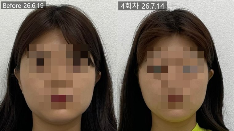 one-sided-jaw-asymmetry 치료 사례 7 — 시술 전후 비교