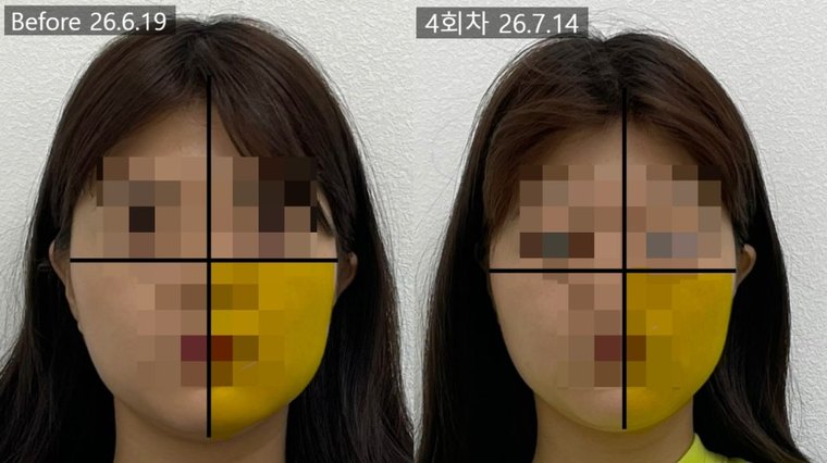 one-sided-jaw-asymmetry 치료 사례 8 — 시술 전후 비교